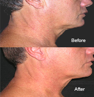 Cosmetic Acupuncture Treatment Before & After 2